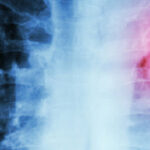 Enfermedad pulmonar obstructiva crónica (EPOC)
