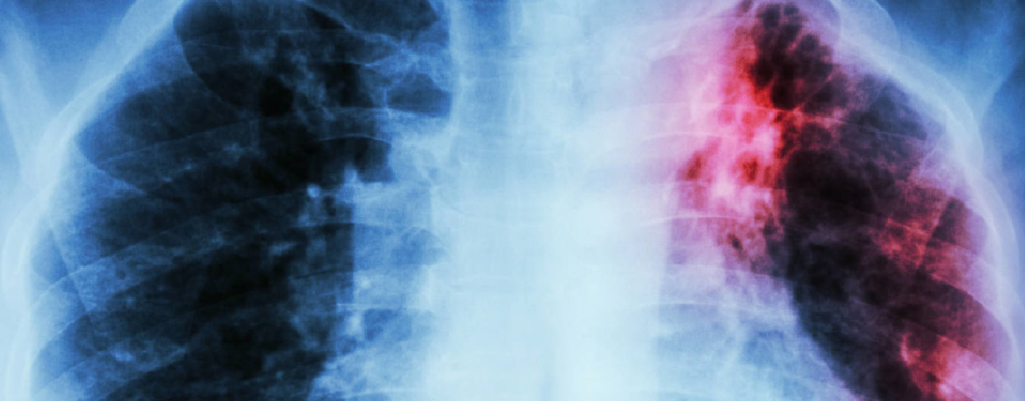 En este momento estás viendo Enfermedad pulmonar obstructiva crónica (EPOC)